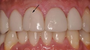 Photo: restauration infructueuse avec des photopolymères sur l'incisive supérieure