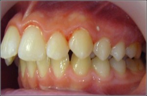 Photo: Malocclusion adulte