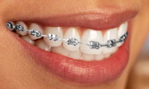Photo: Correction de la malocclusion avec accolades