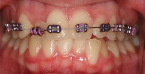 Photo: Correction of cross-bite with braces