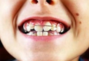 Photo: Correction de la malocclusion chez les enfants