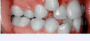 Foto: progenie alveolar del diente