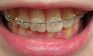 Photo: Treatment of deep bite with braces