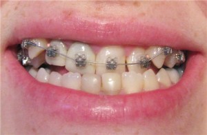 الصورة: علاج لدغة mesial مع الأقواس