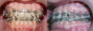 Foto: Tratamiento de ortodoncia con arcos y elásticos.