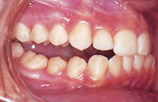 Photo: Open side bite