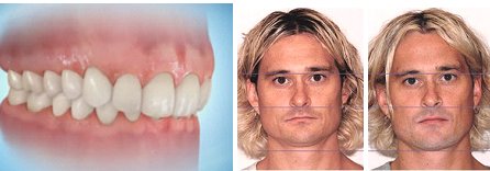 Photo: Facial signs of deep bite.