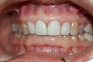 deep bite up