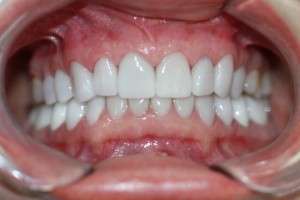 deep bite after