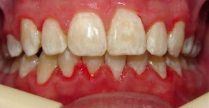 deep bite after