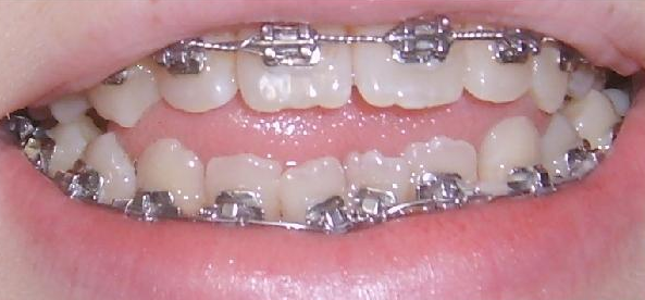 Photo: Bracket system anomaly correction