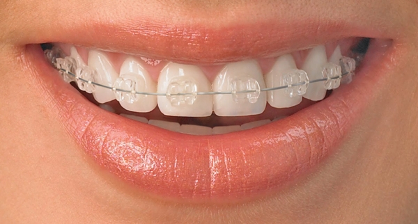 Photo: Correction de la malocclusion avec accolades