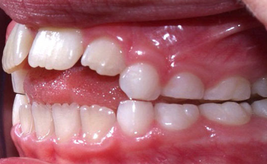 Photo: Open Front Bite