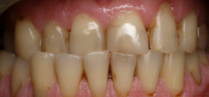 Photo: Cross Bite
