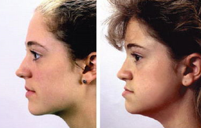 Photo: Malocclusion sagittale