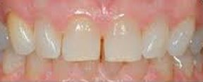 abans de blanquejar les dents