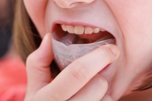 Photo: L'utilisation de formateurs pour corriger la malocclusion