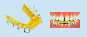 Photo: Appareil orthodontique amovible