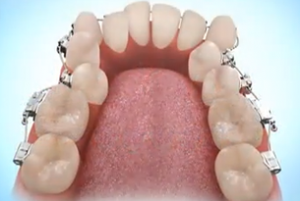 photo avant de fixer les dents avec des accolades