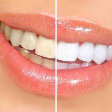 Photo: Dents après blanchiment