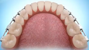 photo: Après avoir bougé les dents