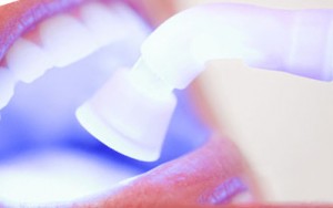 Foto: sbiancamento laser