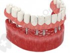 implantation basale