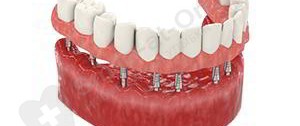 implantation basale