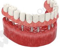 implantation basale