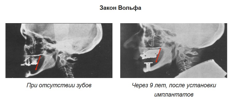 implants réparent l'os